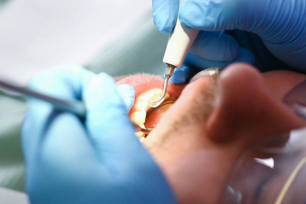 Best Emergency Treatment for Dental Infections or Abscesses in Winters, TX